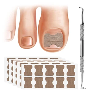 50 PCS Breathable Ingrown Toenail Corrector Patch with Double-Ended Stainless St - Picture 1 of 12