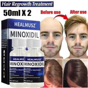 5% Minoxidil Haar Nachwachsen Behandlung Haarausfall & Wachstum Kopfhaut Flüssigkeit Männer Frauen - Bild 1 von 20