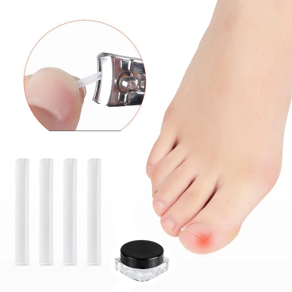 Outil de Correction Des Ongles Incarnés Toe Cleaner Bretelles Soins Des Ongles - Photo 1/1