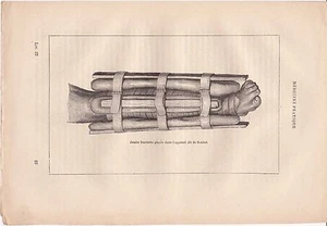 Ancienne gravure médicale 37- Médecine pratique - Jambe fracturée - Scultet - Picture 1 of 1