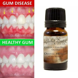 Herbal Dentist Super Potent Gum Disease Cure Stop Bleeding Receding Gums Teeth - Picture 1 of 7