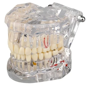 Transparent Disease Teeth Model with Dental Implant Bridge, Dental Model New - Picture 1 of 3