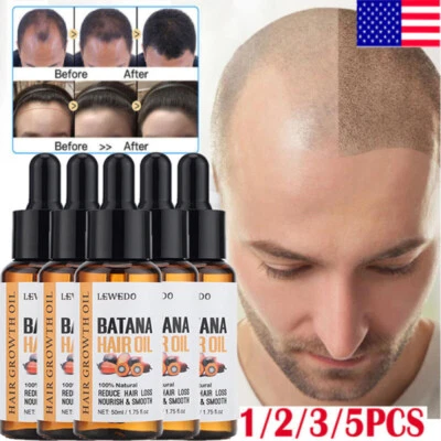 BATANA OIL Serum Hair Growth Natural - Organic Promotes Hair Regrowth Women Men Foto 1 de 4