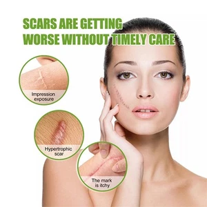 Professional Silicone Scar Sheets Scars Treatment Silicone Scar Strips_X - Imagen 1 de 16
