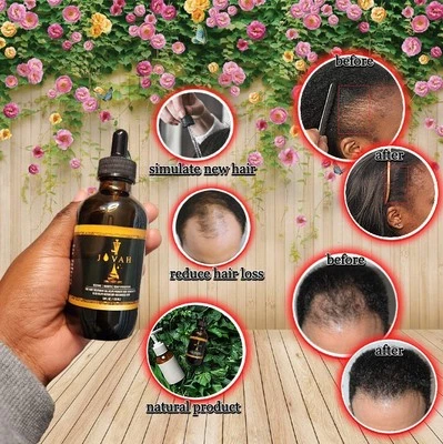 Hair oil Miracle treatment for Hair breakage, Alopecia and Hair loss 100% Active - Image 1 of 4
