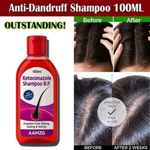 AAMZG  Anti Dandruff Shampoo Reats And Prevents Dandruff Flaky Scalp Shampoo - Picture 1 of 9