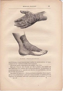 Ancienne gravure médicale 20 - Médecine pratique & populaire - Le Pellagre - Bild 1 von 1