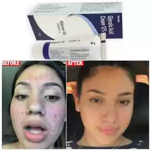 GLYCO 12 Glycolic Acid CREAM 12% Reduce Wrinkles Prevents Acne 30gm + Free Ship - Picture 1 of 4