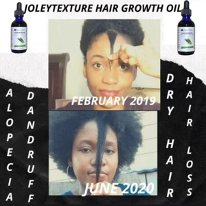 Fast Hair Growth Oil for Alopecia and Hair Loss w/Fenugreek,Aloe & Moringa,2 oz - Picture 1 of 12