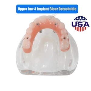 All on 4 Dental Implant Model Overdenture Upper Jaw 4 Implant Clear Detachable - Picture 1 of 16