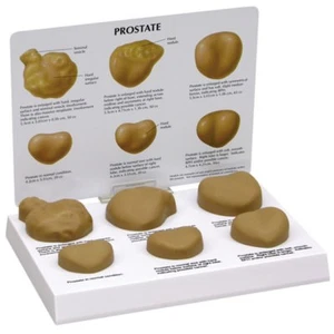 Set modello anatomico prostata GPI scheda BPH LFA #3000. Fateci un'offerta! VEDI VIDEO - Foto 1 di 2