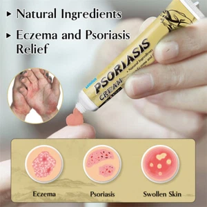 Psoriasis Creme Natürliche Inhaltsstoffe für Dermatitis Ekzem Psoriasis Relief - Bild 1 von 9