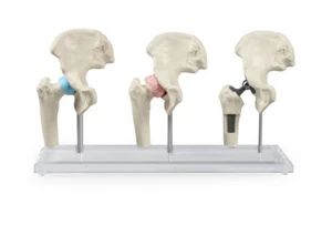 Anatómico Modelo Cadera, Implantes Muslo , Hüftimplantat - Imagen 1 de 4
