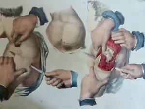1850 ANATOMIE CHIRURGIE Amputation du bras 1 LITHOGRAPHIE - Imagen 1 de 3