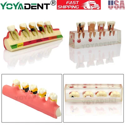 Стоматологическая модель в ассортименте заболеваний пародонта эндодонтическое обучение демонстрация США - Изображение 1 из 4