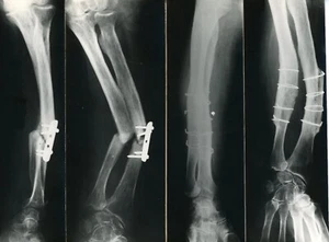 Photo médicale curiosité radiographie, os BONE tige métallique broche - Imagen 1 de 2