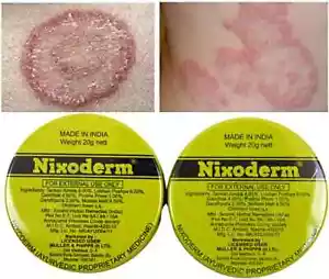 3 x Nixoderm Cream 20g For Skin Problems Eczema Ringworm Blemishes & Pimples - Picture 1 of 9