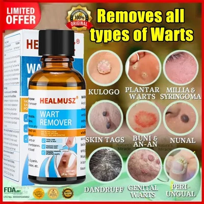 Wart Remover Liquid Skin Tag Mole Remover Eliminate Feet Corn Wart Remove Liquid - Image 1 of 4