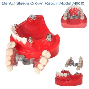 Restauración de implantes dentales modelo PRD dentadura parcial superior tipodonte - Imagen 1 de 9