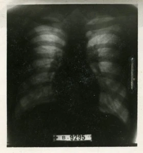 Wissenschaftliche radiologische Untersuchung der Lunge Frankreich alte Radiofotografie 1948 - Bild 1 von 3