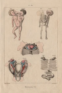 SIAMESISCHE ZWILLINGE. "Monstruosités" II. Verbundene Zwillinge 1833 alter antiker Druck - Bild 1 von 1