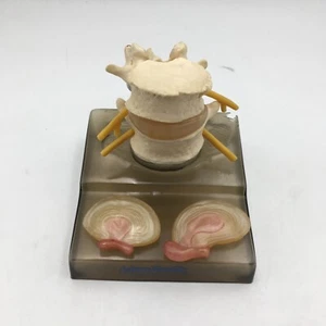 SOMSO QS68/3 Central and Dorsolateral Hernia Model of Intervertebral Disc - Picture 1 of 4