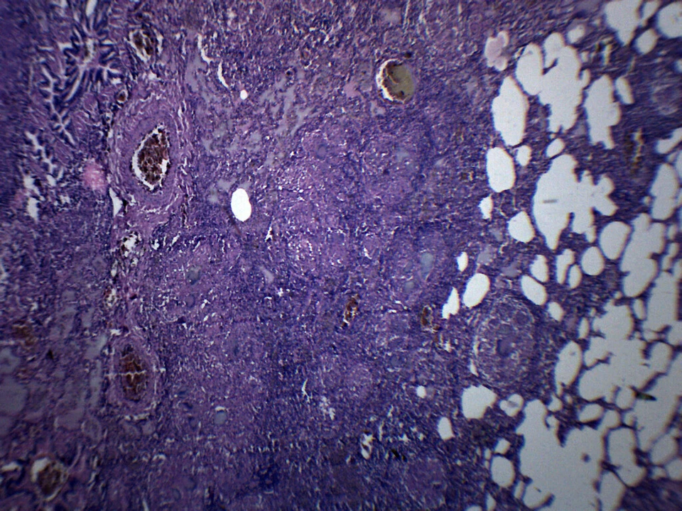 Tuberculosis, Sección Pulmonar Humana - Diapositiva Preparada - 75x25mm - Eisco Labs Foto 1 de 1