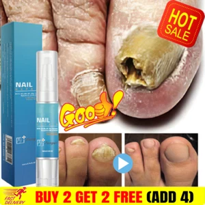 Pluma de tratamiento de hongos en uñas anti infección por hongos reparación biológica solución cuidado - Imagen 1 de 9