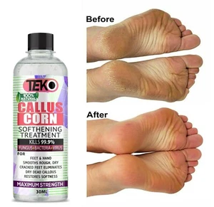 Corn and calluses remover Gel Foot callus removal treatment Hard skin Pedicure - Picture 1 of 1