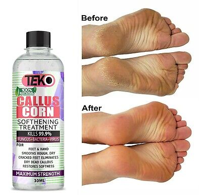 Corn And Calluses Remover Gel Foot Callus Removal Treatment Hard Skin Pedicure • 5.33£