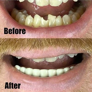 Denti inferiori flessibile impiallacciatura inferiore finto cosmetico sorriso sicuro sorriso istantaneo - Foto 1 di 5