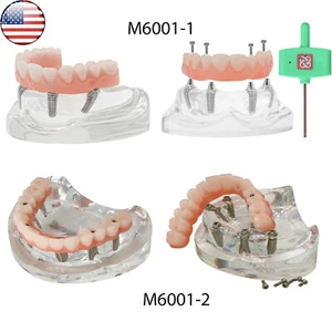 US Dental All-on-4/6 Screws Overdenture Implant  Model Upper Jaw Restoration - Picture 1 of 30