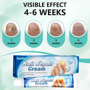 Crema antifúngica eliminación de hongos crema tratamiento infección uñas de los pies cuidado - Imagen 1 de 10
