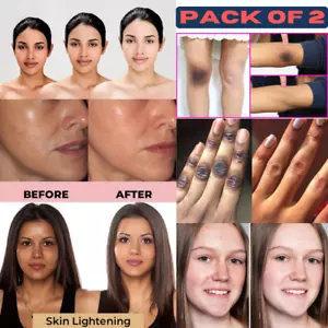 Dark Skin Bleaching Cream Whitening Lightening AHA - Face & Body - 15g 2er Pack - Bild 1 von 8