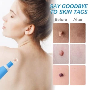 2 In 1 Micro Warzenentferner Painless Auto SKIN TAG Removal Kit Bands Remover - Bild 1 von 15