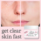 YUMMY MUMMY AFTER BIRTH SPOTS & PIMPLES CREAM TREATMENT CLEAR COMPLEXION