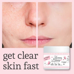 YUMMY MUMMY AFTER BIRTH SPOTS & PIMPLES CREAM TREATMENT CLEAR COMPLEXION - Picture 1 of 2