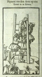 Gravure tirée de PARÉ Ambroise, RÉDUCTION D'UNE FRACTURE, ATTELLE DU BRAS - Imagen 1 de 3