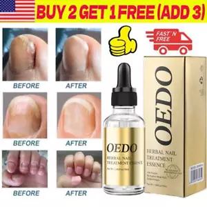 2025 Fungal Nail Treatment Essential oil Hand and Foot Nair Fungus Removal Oil - Picture 1 of 12
