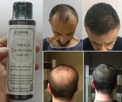 Hair Growth Oil Serum DHT-Alopecia-Thinning Hair-Balding 3.4 oz. - (100ml) - Image 1 of 4