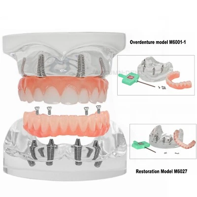 Dental Upper/Lower Jaw Type All on 4 Overdenture Modle With 4 Screws Restoration - Image 1 of 4