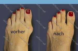 Fußbandage Hallux Valgus 2x Schiene Reibungsschutz Ballenschutz Valgus Pro - Bild 1 von 2
