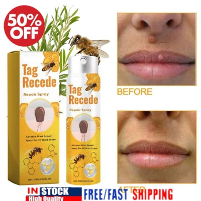 MARKENLOS Tag Receede Bienenspray, Bienengift Warzen Entfernung Pflege Spray 20ML