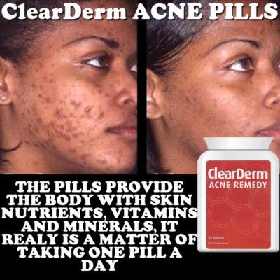 CLEARDERM ACNE PILL TABLET STOP PIMPLES SPOTS MAX STRENGTH - Image 1 of 2