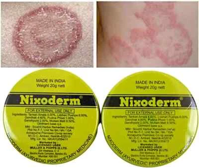2 x Nixoderm Cream 20g For Skin Problems Eczema Ringworm Blemishes & Pimples
