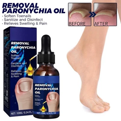 10ML Removal Paronychiaoil Ingrown Oil Nail Renewal D4L3 For Hard*Cracked G0Y8 - Image 1 of 4