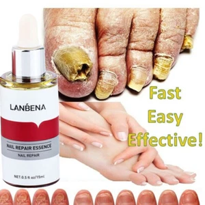 LANBENA Nail Repair Essence Remove Onychomycosis Serum Fungal Nail Treatment - Picture 1 of 14