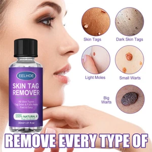 10/30ML Skin Tag Remover For Remove Skin Tags Light Moles Common Warts - Picture 1 of 10