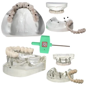 Dental Implant Model Upper All-on-4 overdenture 4 Screws titanium frame Clear - Picture 1 of 45