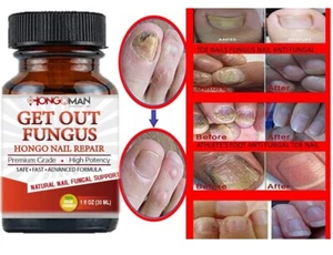 ANTI FUNGAL Support EXTRA STRENGTH TOENAIL FUNGUS ATHLETES FOOT FUNGI NAIL #1 - Picture 1 of 10